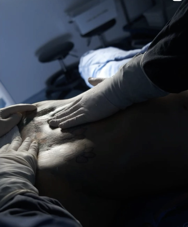 Abdominoplastia Dr Julian Pacheco